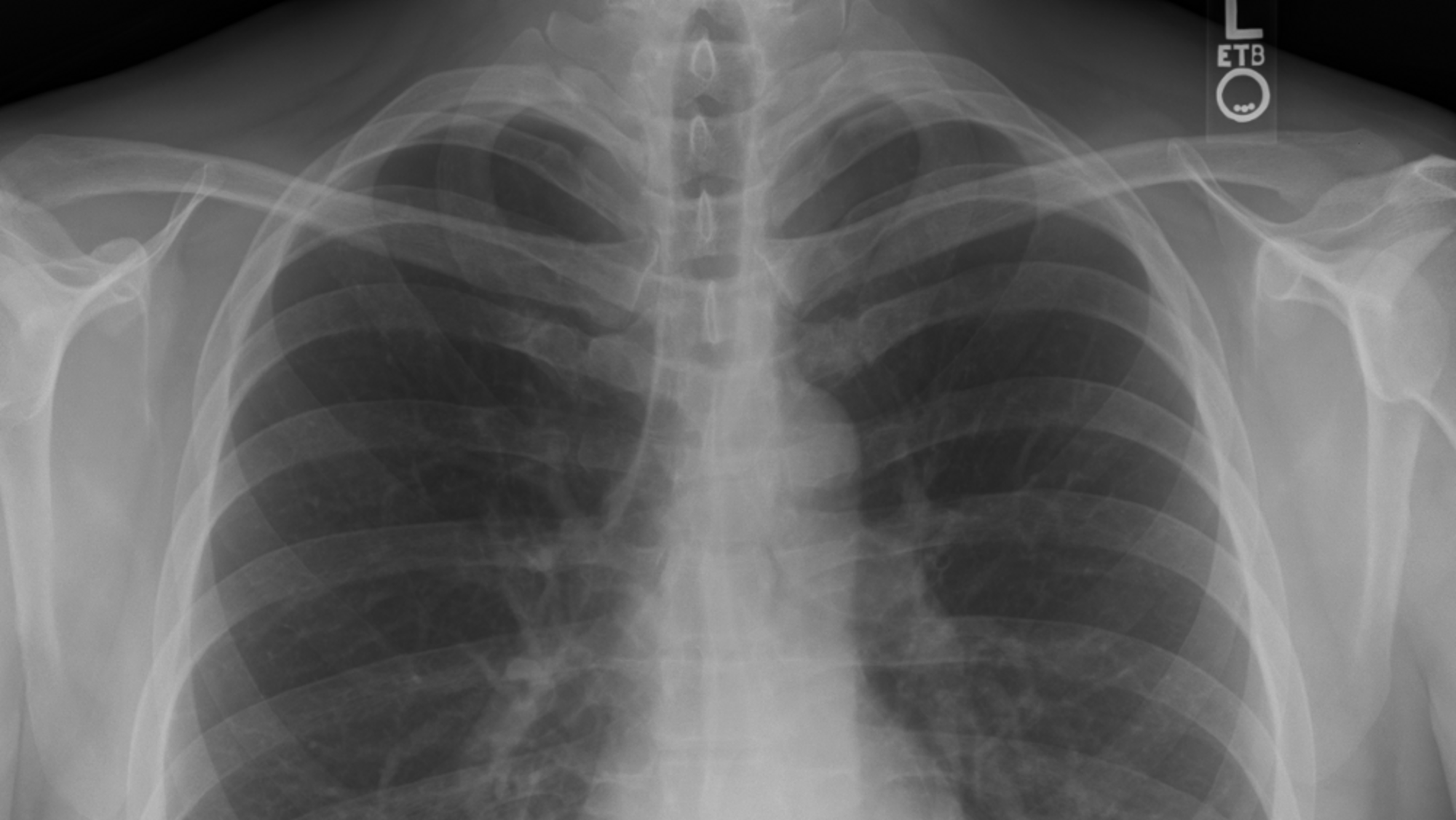 A chest x-ray